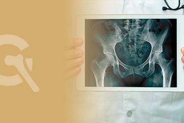 O Que é Impacto Femoroacetabular? Um Guia Completo para Iniciantes