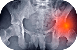 Impacto Femoroacetabular 