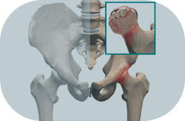 Osteonecrose de quadril 