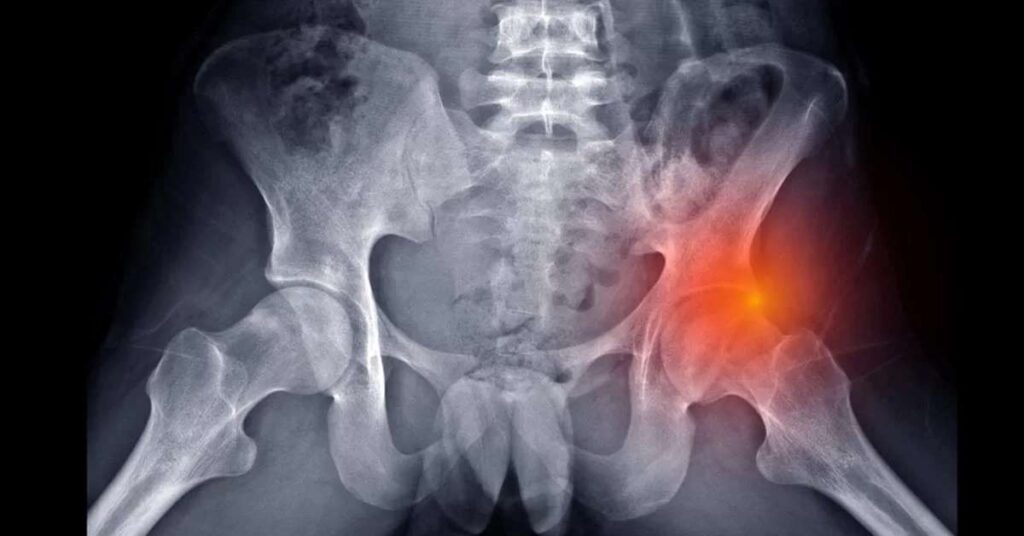 Qual é a relação entre impacto femoroacetabular e dor no quadril