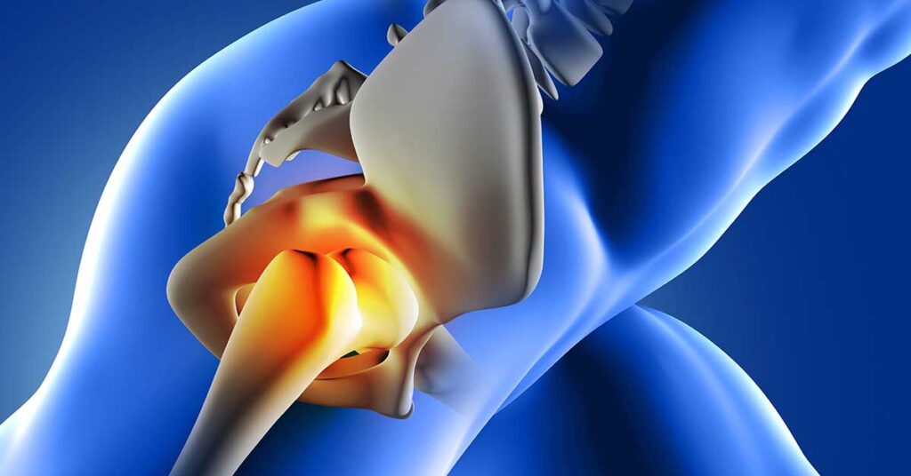 Osteonecrose de quadril em atletas: prevenção e manejo